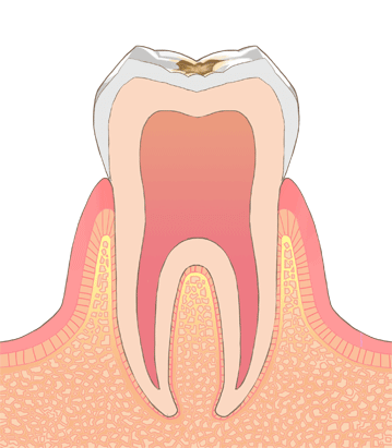 C1：初期虫歯