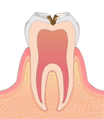 C2：中程度の虫歯