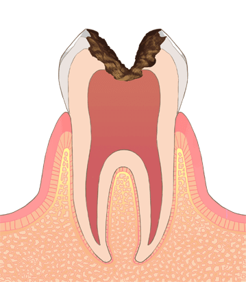 C3：大きな虫歯