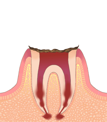 C4：虫歯が進行し、歯の根だけが残っている状態