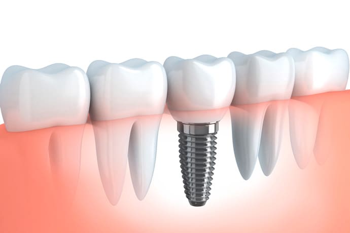 インプラントは第二の永久歯