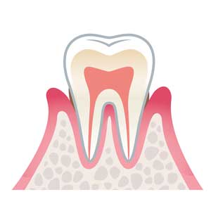 中等度の歯周炎
