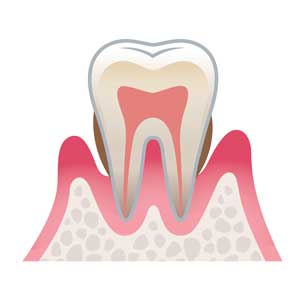 重度歯周炎