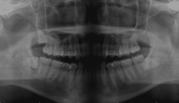 親知らず抜歯および含歯性嚢胞摘出術前・術後