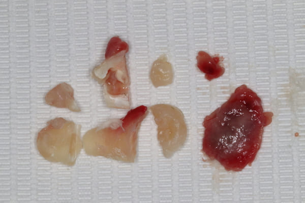 親知らず抜歯および含歯性嚢胞摘出術前・術後