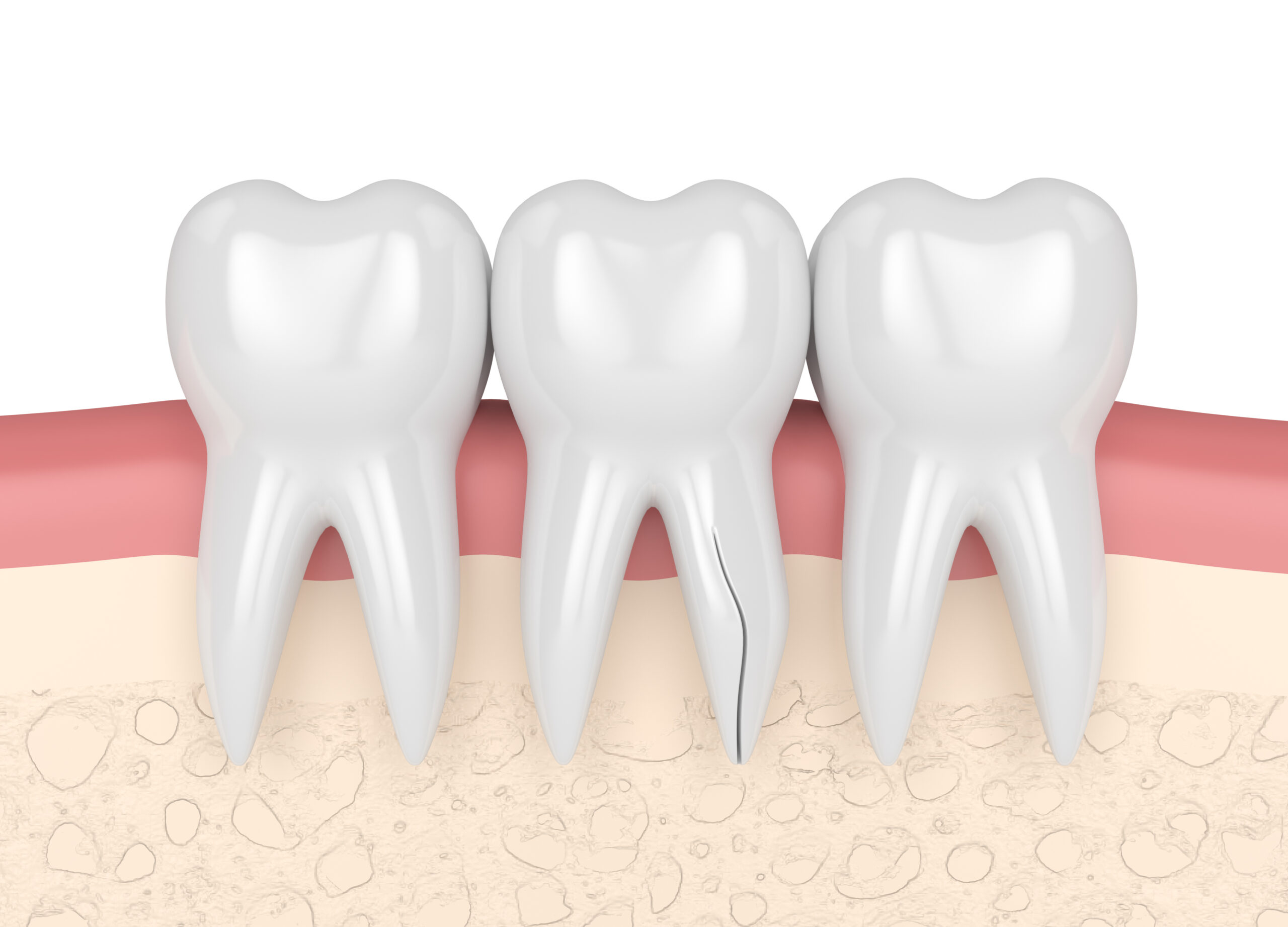 3d render of gums with cracked tooth root over white background. Vertical fracture. Different types of broken teeth concept.