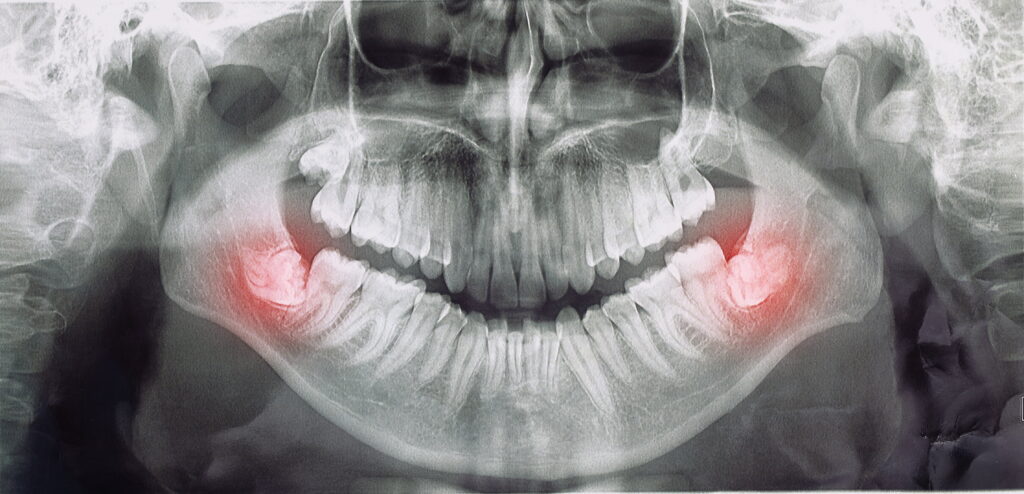 親知らずと歯並びの関係のイメージ