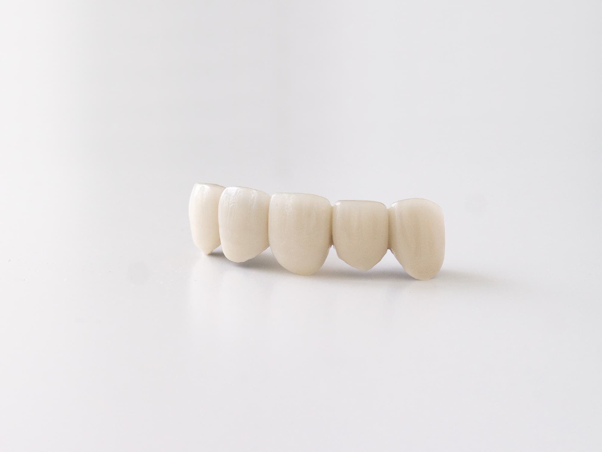 前歯のブリッジ