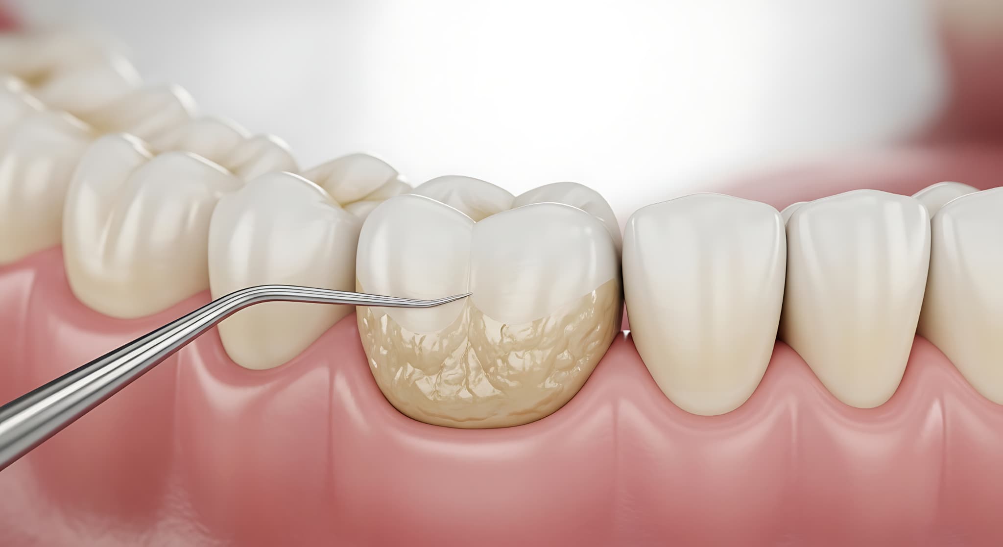 プラークについて説明するイメージ