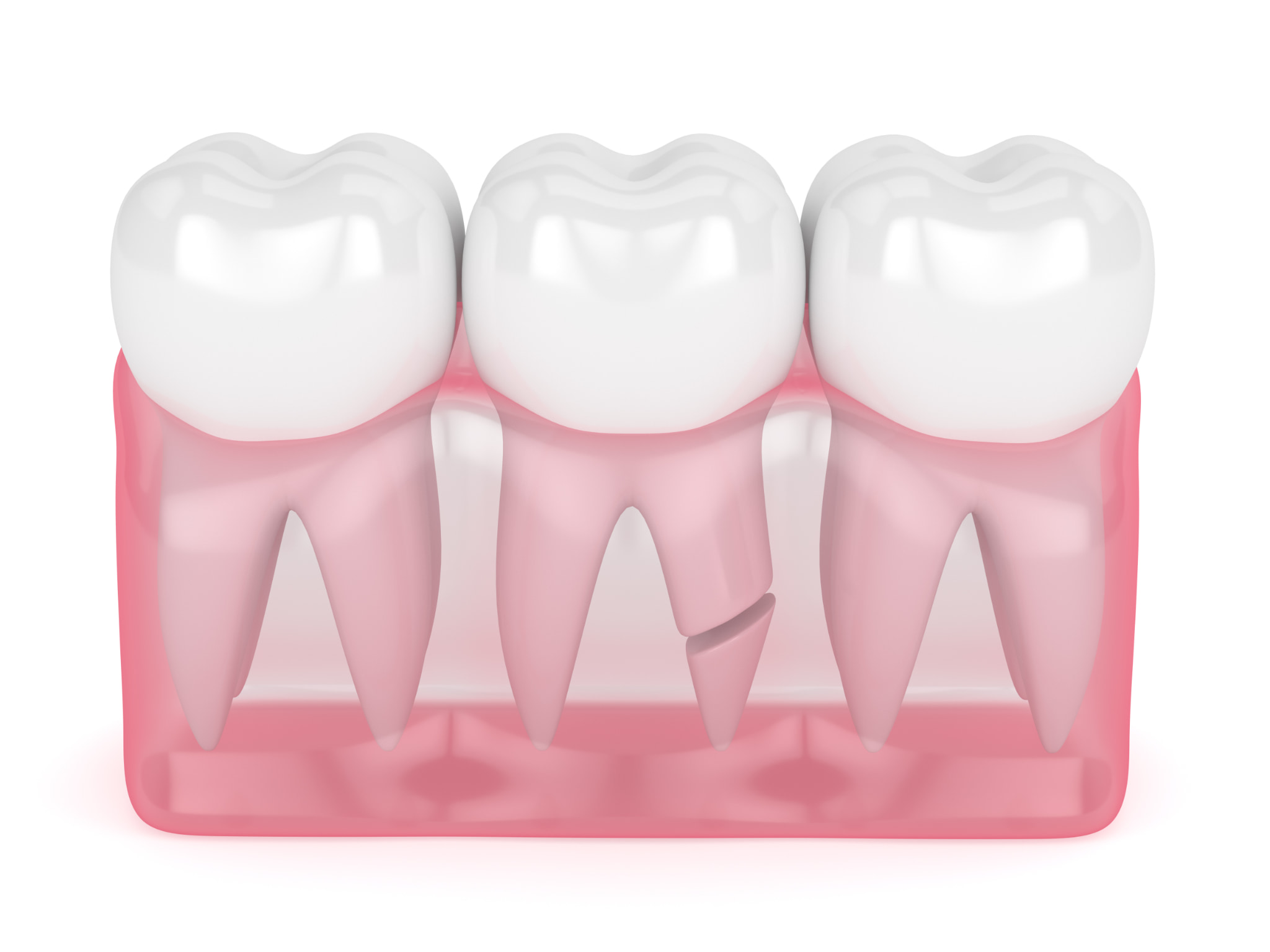 歯根が破折しているイメージ