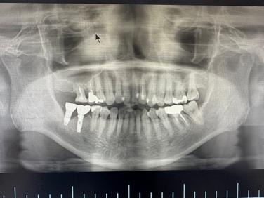 インプラント周囲炎の人のレントゲン写真