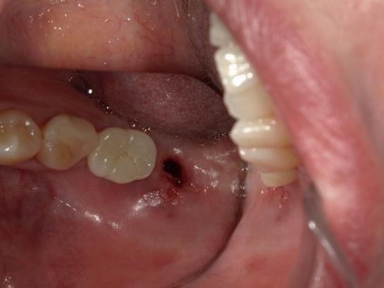 インプラント除去後の口腔内