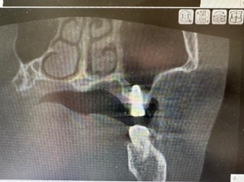 ソケットリフトおよびインプラント体埋入
