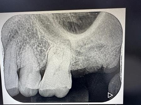 ソケットプリザベーション