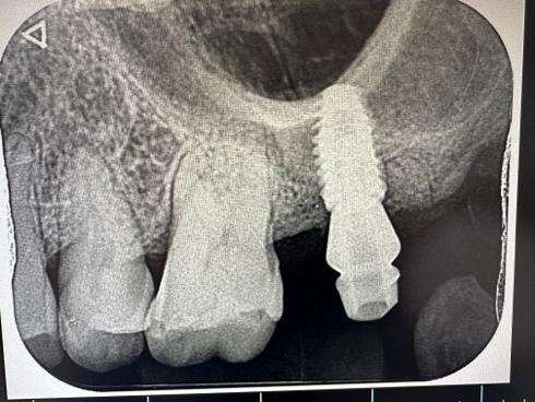 アバットメントおよび上部構造の装着