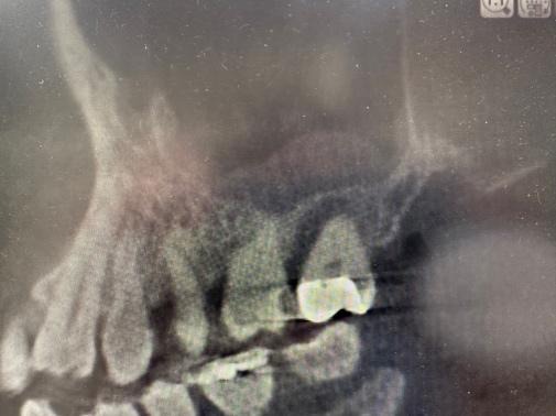 ソケットリフト