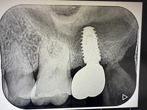 アバットメントおよび上部構造の装着
