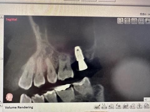 ソケットリフトおよびインプラント体埋入