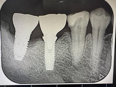 インプラント周囲炎のレントゲンの拡大写真