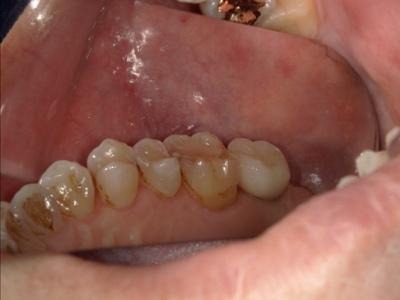 アバットメントおよび上部構造の装着