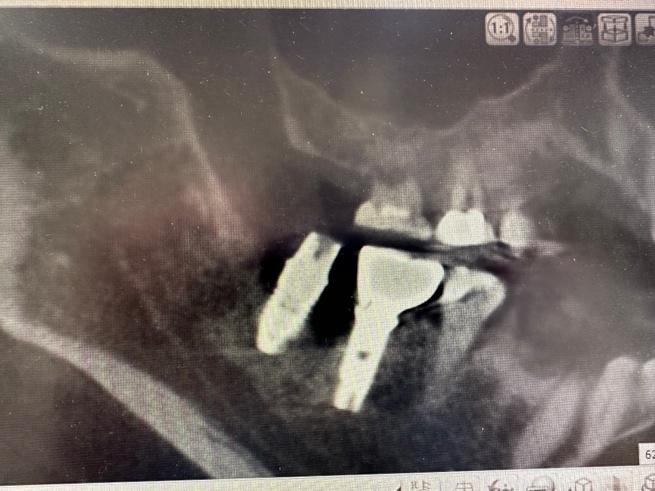 インプラント周辺の骨が溶けたレントゲン写真