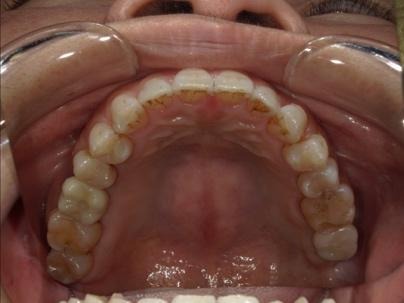 アバットメントおよび上部構造の装着