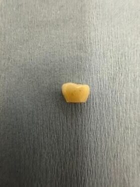 除去したインプラントの被せ物