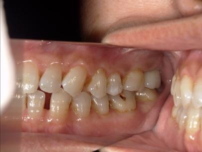 アバットメントおよび上部構造の装着