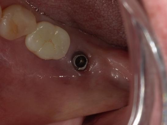 インプラント体除去前の口腔内