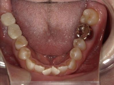インプラント周囲炎になった口腔内