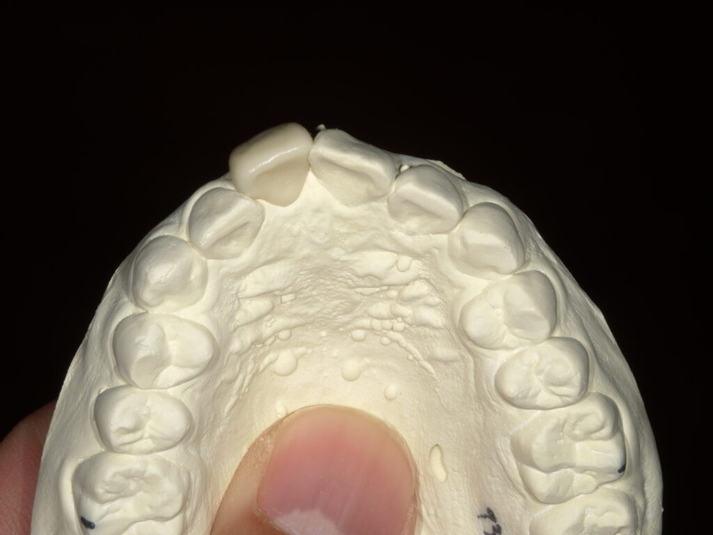 下から見た被せ物の模型