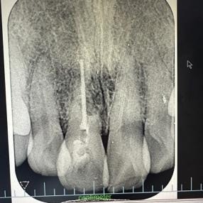 前歯のレントゲン写真