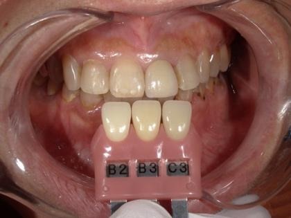 歯の色を確認する様子①