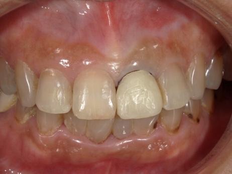 仮歯を装着した様子