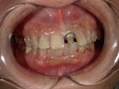 レジン前装冠を外した様子