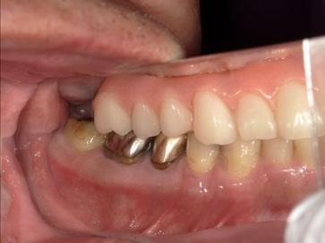 治療前の右側の様子