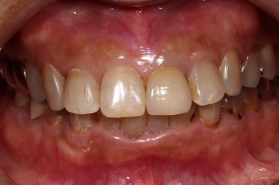 被せ物を装着した様子①