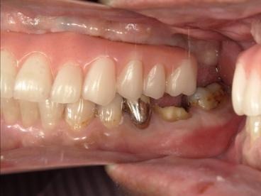 治療前の左側の様子