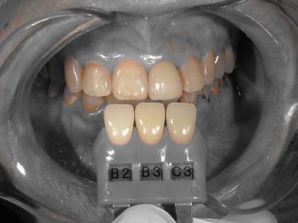 歯の色を確認する様子②