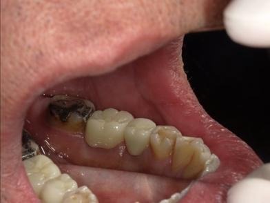 上から見た治療後の口腔内②