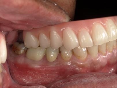 横から見た治療後の右側