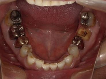 治療前の口腔内