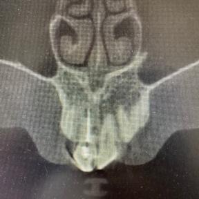 前歯のレントゲン写真