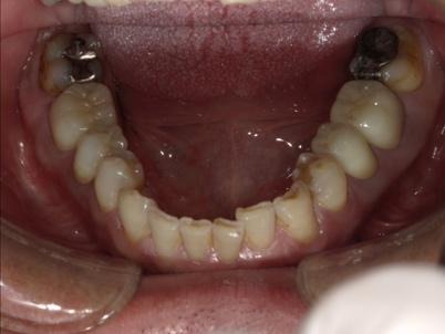 左右1本ずつをジルコニアクラウンへ変更した口腔内