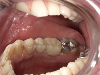 上から見た治療後の口腔内①