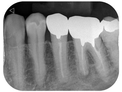 治療前の銀歯のレントゲン写真