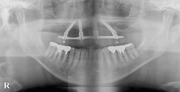 治療前のレントゲン写真