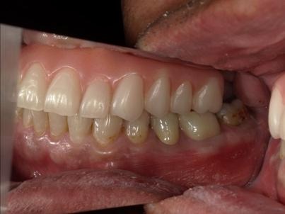 横から見た治療後の左側