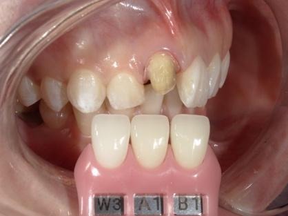 横から歯の色を確認する様子