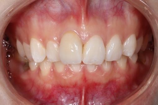 被せ物を装着した前歯①